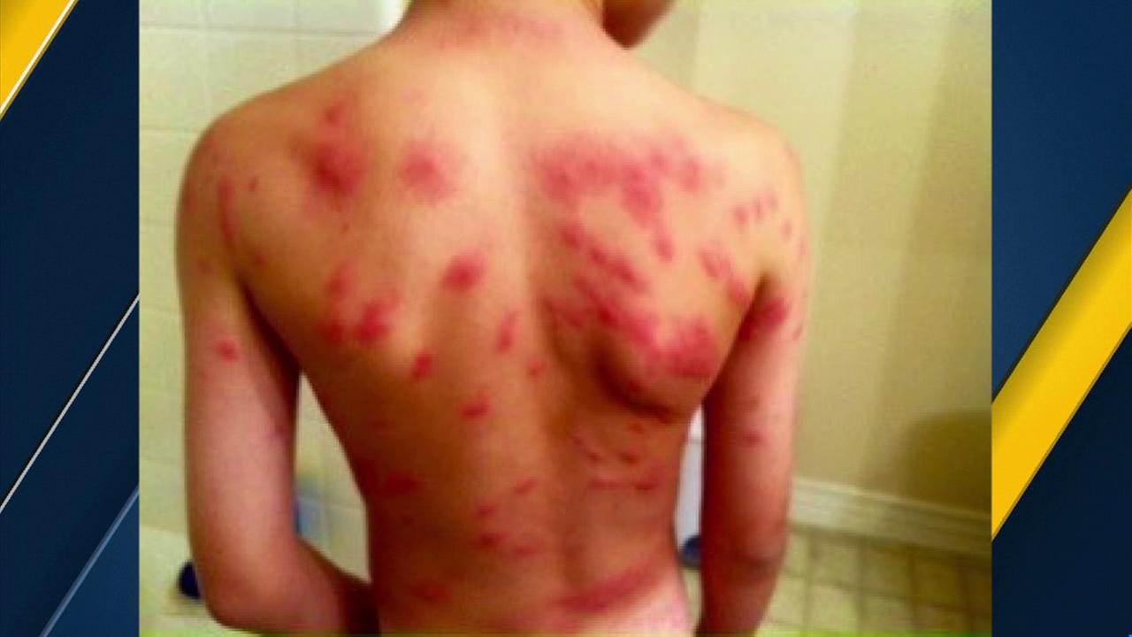 Dozens suffering from possible bug bites at Lake Forest Elementary