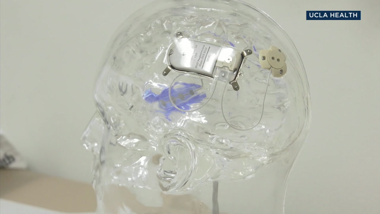 Implant device for epilepsy patients can help keep seizures under