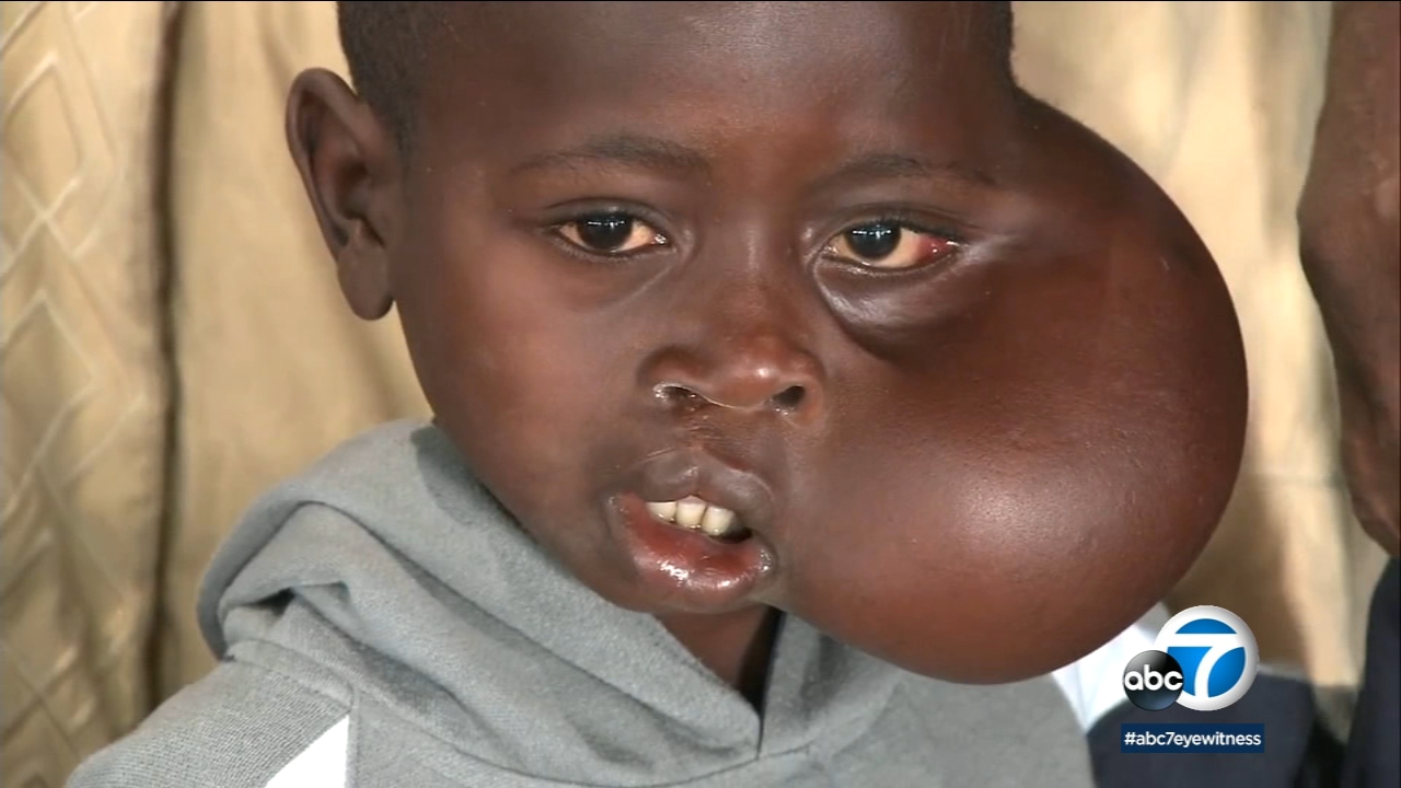 8-year-old Congolese boy dies after undergoing surgery in Los Angeles to remove facial tumor | abc7.com