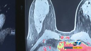 健康・医学 Breast Cancer Tracy-Ann Moo, MD - MSK Breast Surgeon