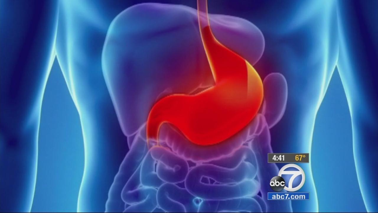 natural-remedies-to-relieve-symptoms-of-acid-reflux-abc7