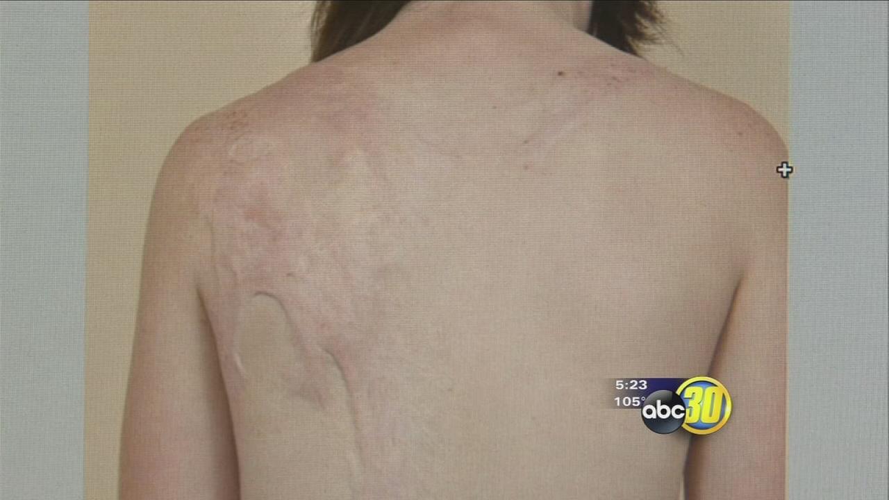 Healing Burn Scars | abc30.com