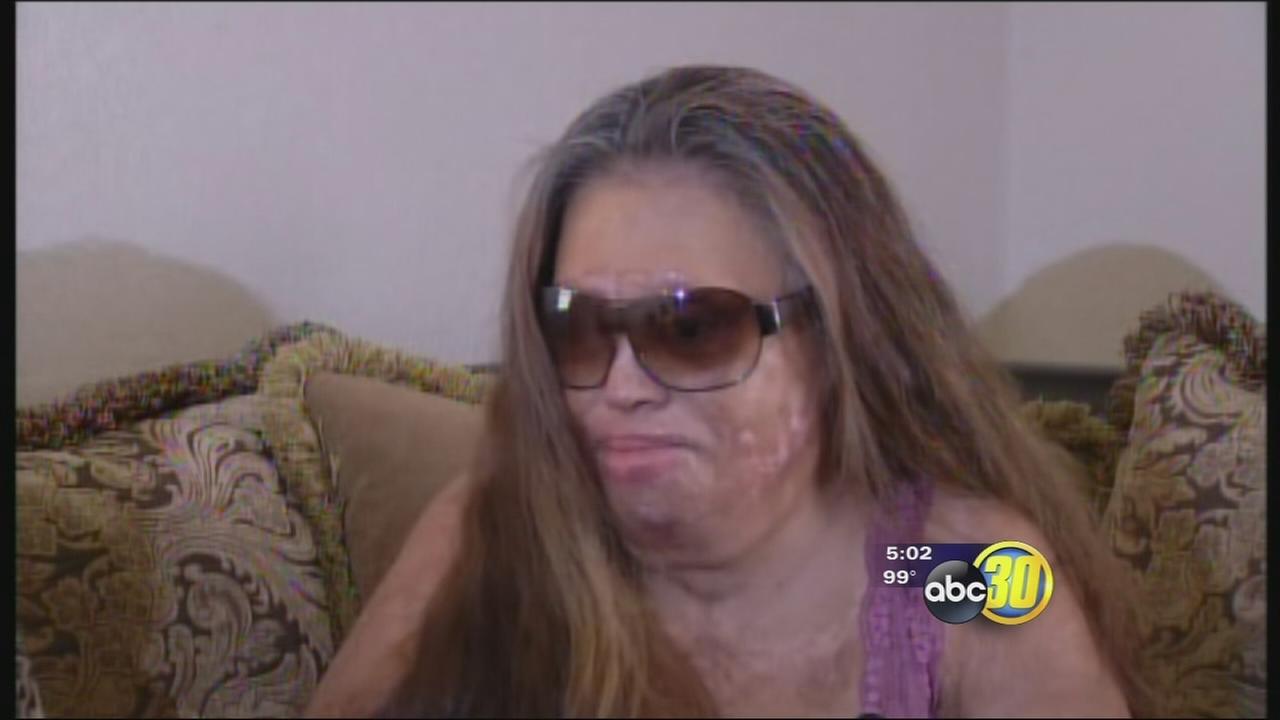 Burned Lemoore woman seeks help to replace eye, ears