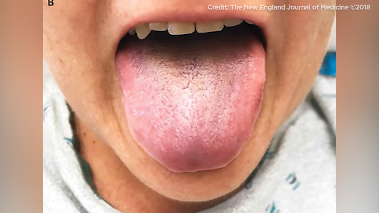 Woman develops 'black, hairy tongue' after being treated with antibiotics