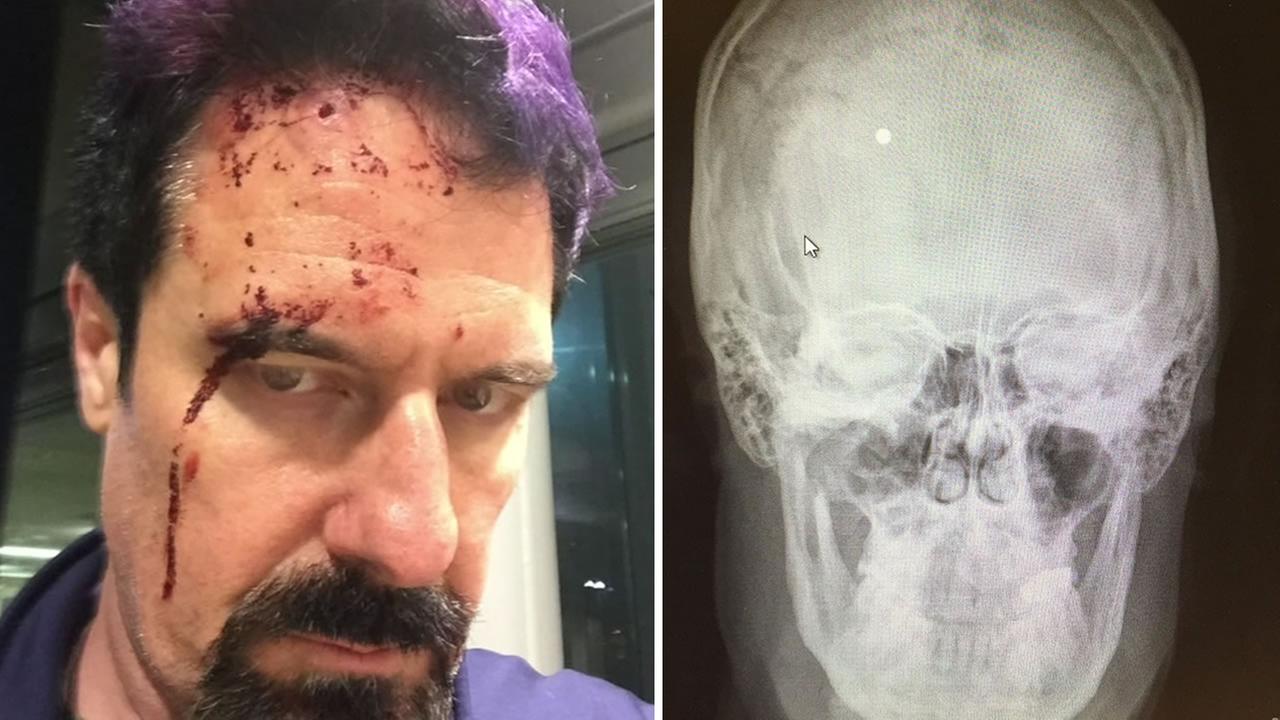 Bay Area man shot in head with BB gun speaks out; Police seek suspects