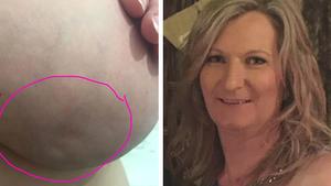 Woman Shares Photo Of Inflammatory Breast Cancer Symptom In Hope