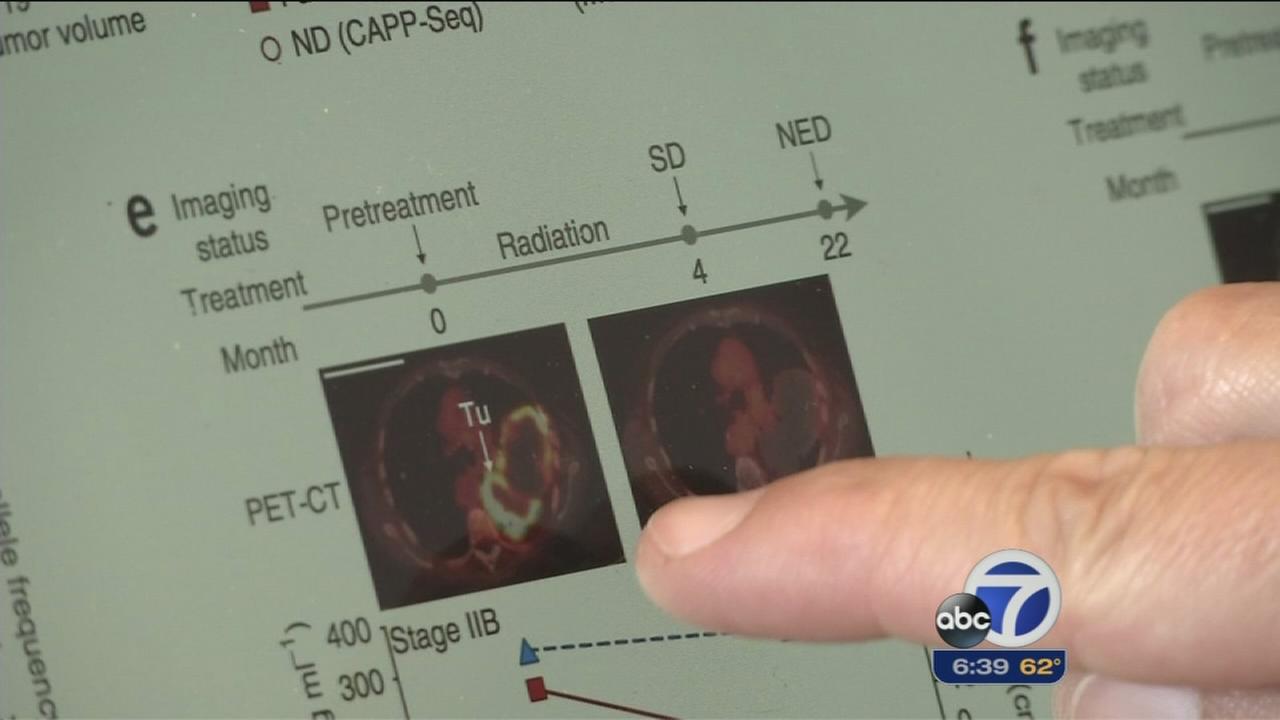 New test spots traces of early lung cancer