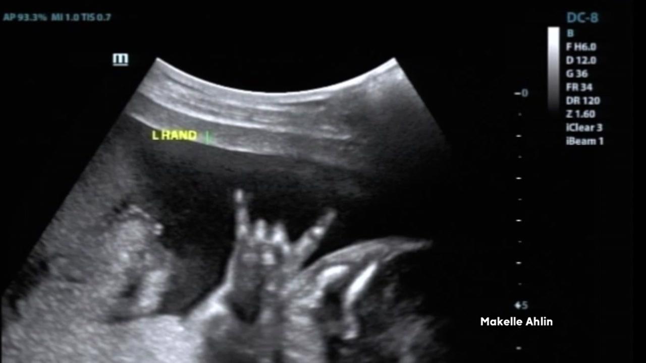 Baby in ultrasound throws up the �rock on� gesture
