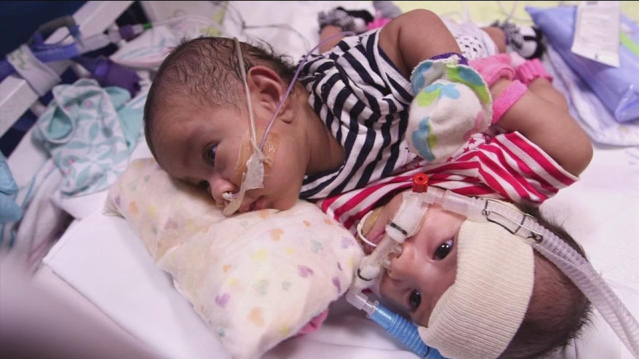 First look at conjoined twins born in Texas