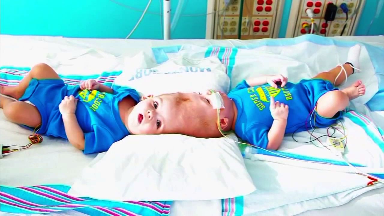 Twins Conjoined At Head Reunited After Risky Separation Surgery In Nyc 6abc Philadelphia 