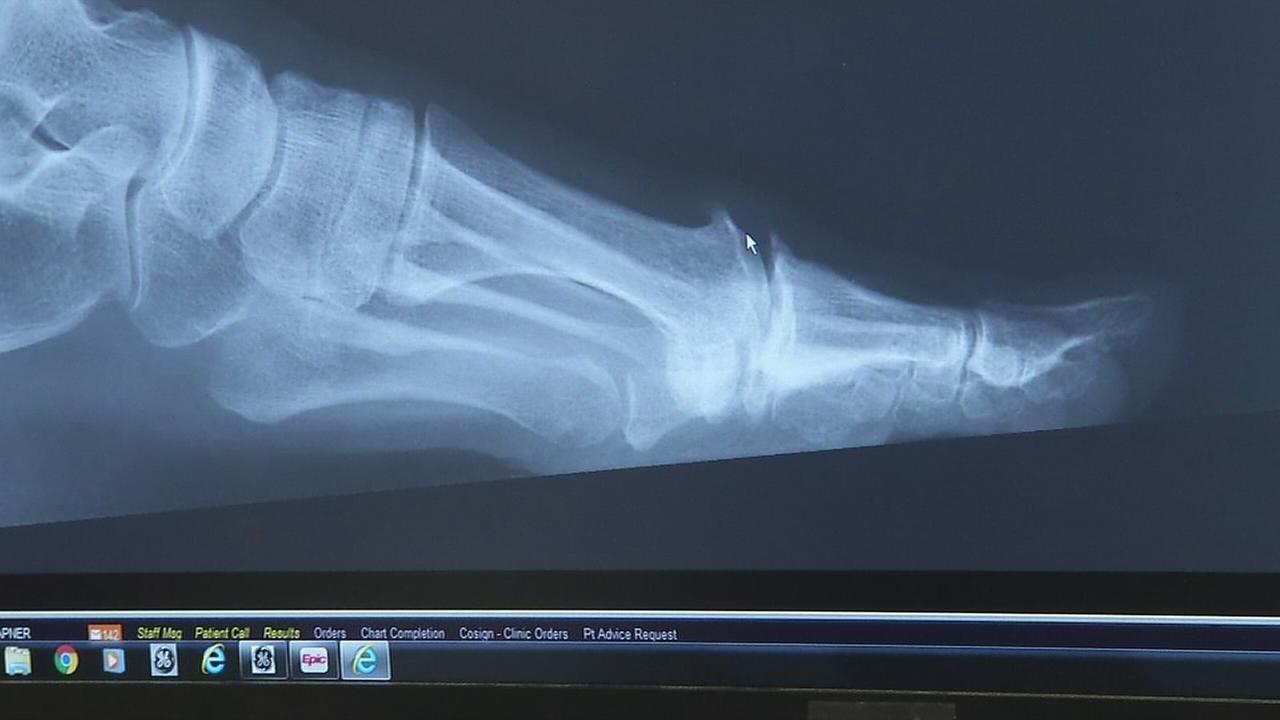 Fixing painful toe joints with Cartiva, first synthetic cartilage