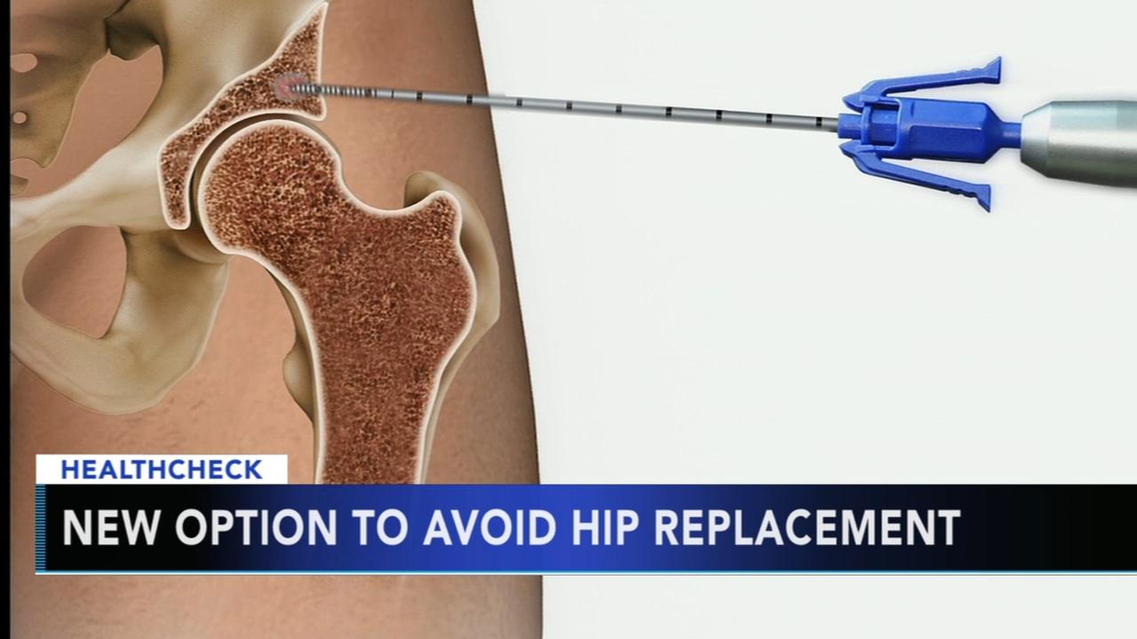 New hip repair method helps younger patients avoid joint replacement