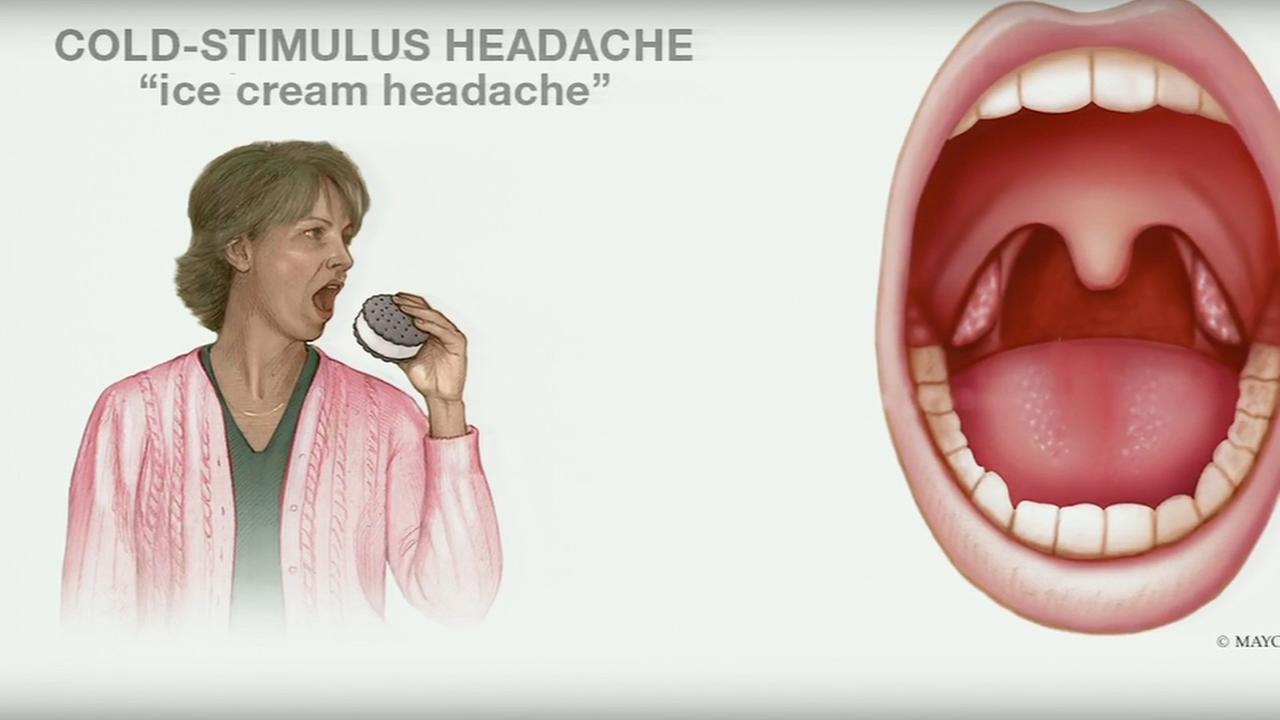 What causes brain freeze and how to prevent it