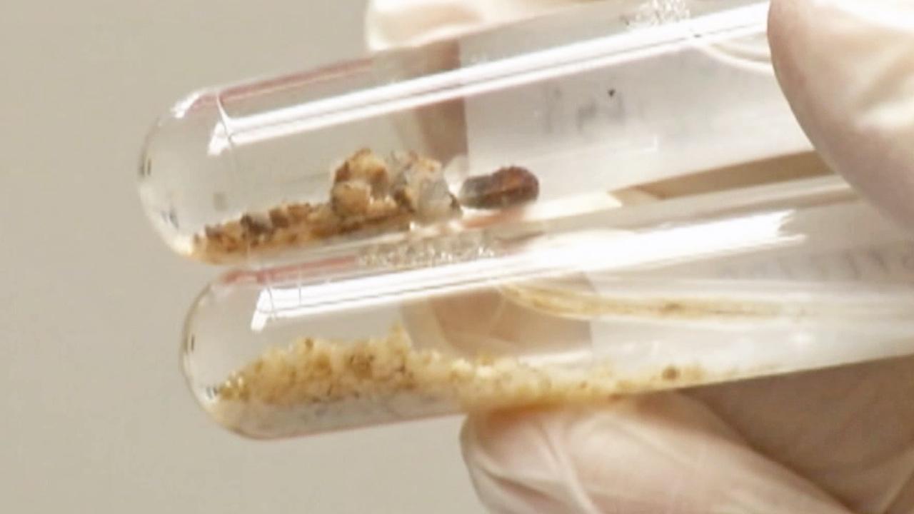 Kidney stones: New, non-invasive treatment breaks down large stones ...